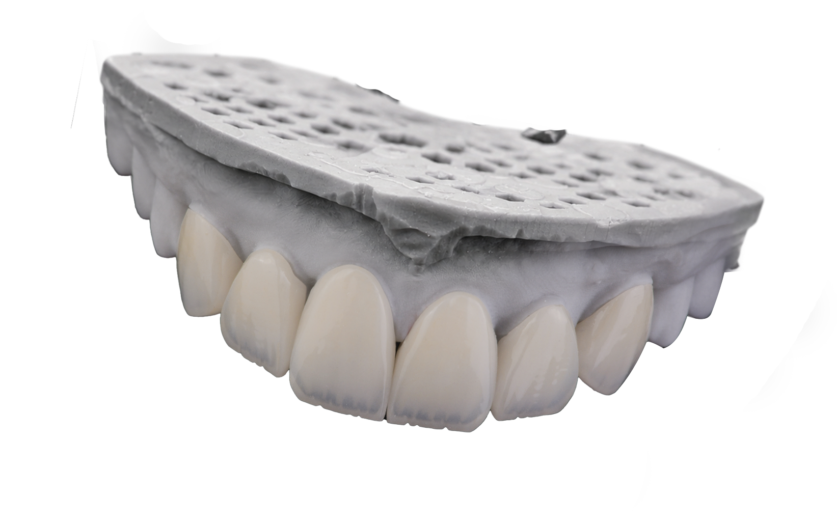 Hand-layered Emax veneers on the working model